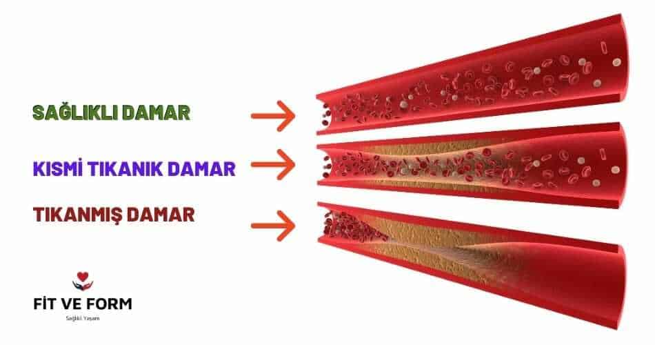 damar tıkanıklığı